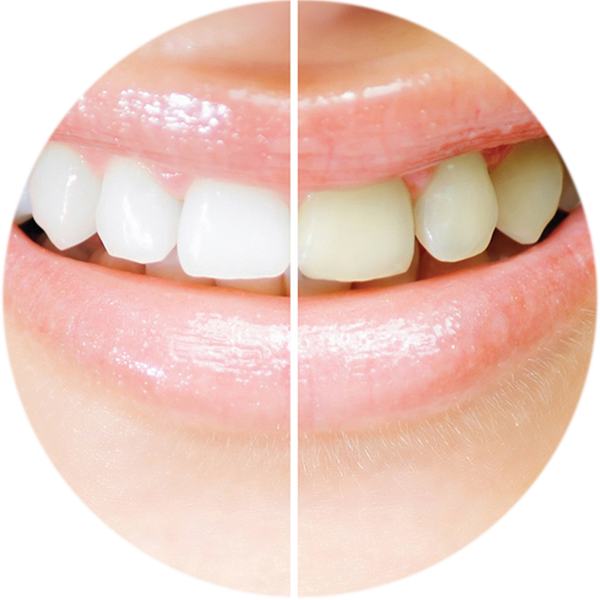 Tooth Fairy tannbleking Clinique Madeleine